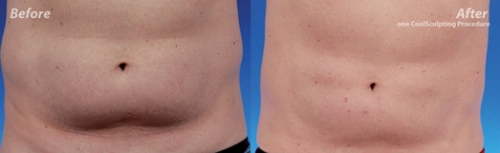 22379-coolsculpting_2.jpg 22379-coolsculpting_2.jpg
