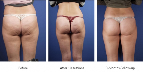 88492-acoustic_wave_therapy_before_and_after.jpg 88492-acoustic_wave_therapy_before_and_after.jpg