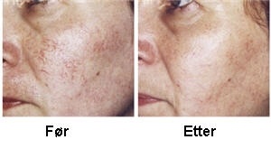 Hudspesialisten Sprengte Blodkar