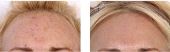 75112-melasma-fraxel.jpg