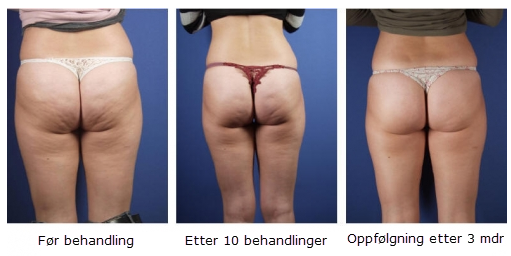 hvordan fjerne cellulitter hvordan fjerne cellulitter